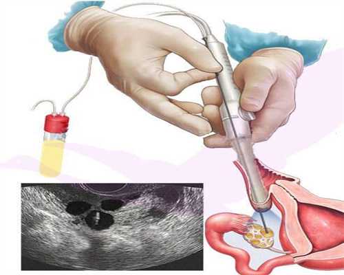 广州正规代怀孕机构怀孕初期出现这3种症状无需