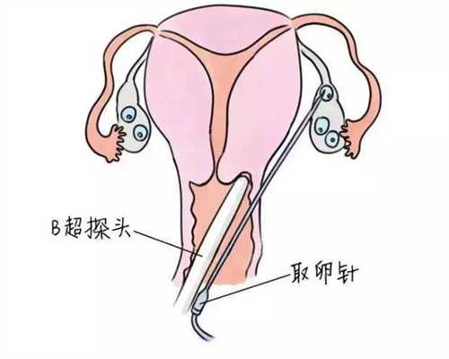 广州代孕网招聘月经前同房竟然怀孕了