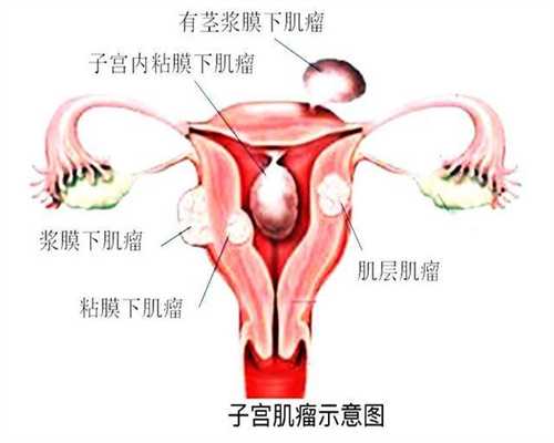 广州代孕费用女性怀孕初期症状小腹疼痛该咋办
