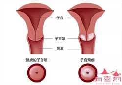 广州孕一个孩子多少钱早期卵巢早衰有什么症状